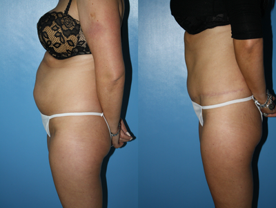 Abdominoplasty with suction-assisted lipectomy - 
	Mother of two presented with abdominal laxity and excess skin. Tummy tuck carried out to remove abdominal apron along with muscle repair and liposuction to provide patient with nice result.
