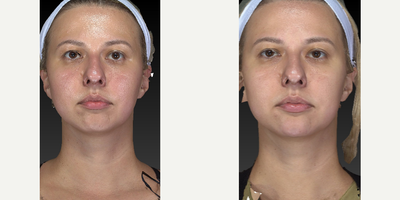 25-34 year old woman treated with Injectable Fillers - This young pretty girl came in for some chin and jawline sculpting. Dr. Caughlin is becoming known for these procedures. Pay attention to the angle of the jaw and chin projection.