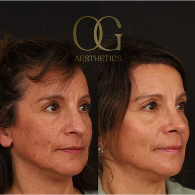 Rhinoplasty before and after photo