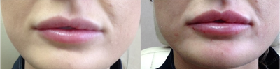 Dermal Fillers before and after photo