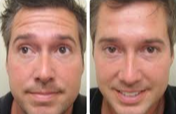Botox before and after photo