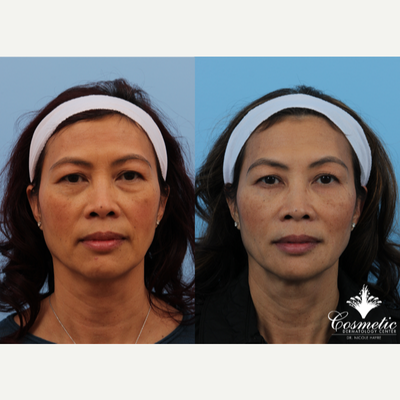 Thread Lift before and after photo