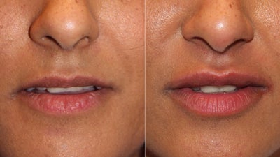 Lip Fillers before and after photo