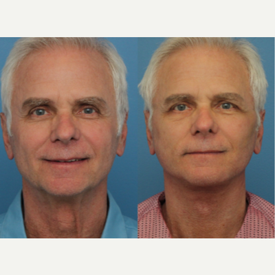 Facelift before and after photo