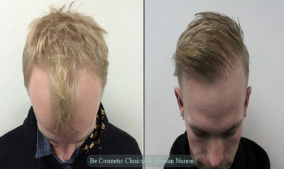 Hair Transplant before and after photo