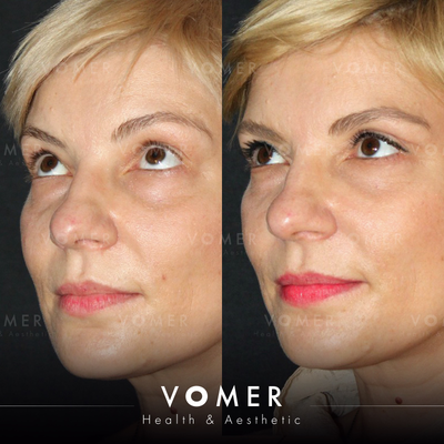 Eyelid Surgery before and after photo