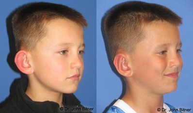 Ear Surgery before and after photo