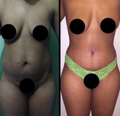 Tummy Tuck before and after photo