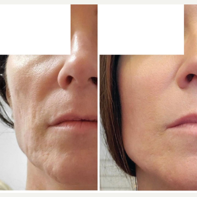 CO2 Laser before and after photo