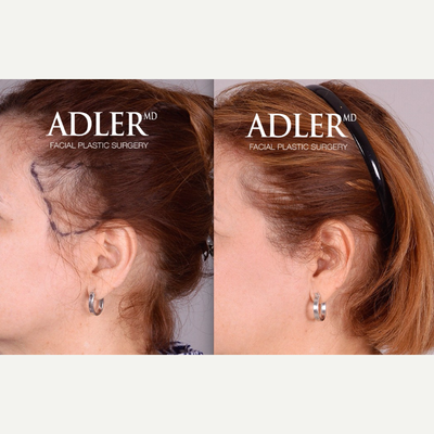 NeoGraft before and after photo