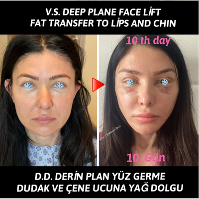 Facial Fat Transfer before and after photo