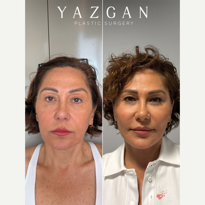 Deep Plane Facelift before and after photo