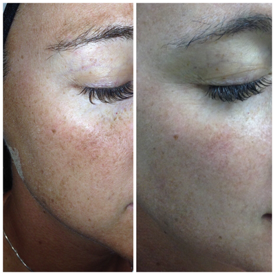 IPL before and after photo