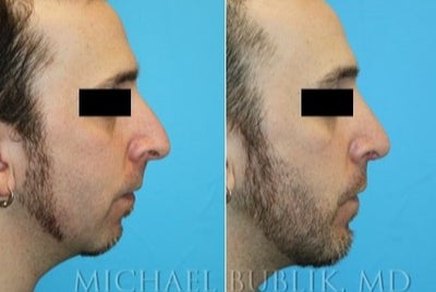 Chin Implant before and after photo