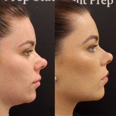 Dermal Fillers before and after photo