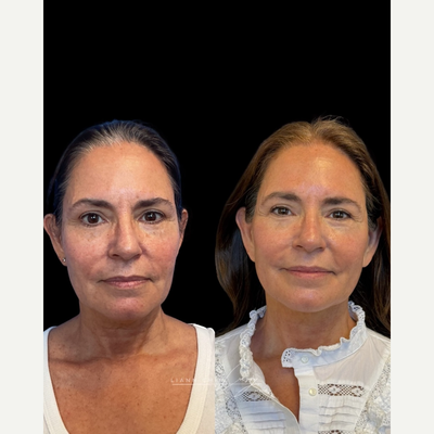 Neck Lift before and after photo