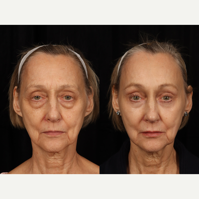 Eyelid Surgery before and after photo