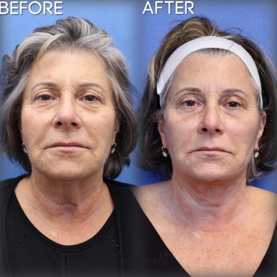 Facelift before and after photo