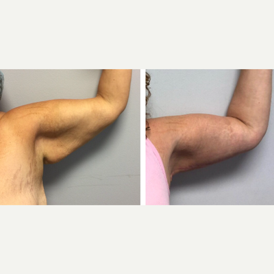 Arm Lift before and after photo