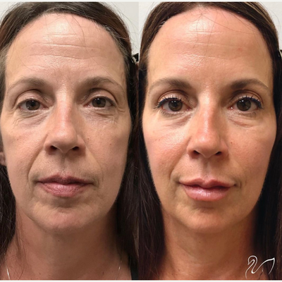 Dermal Fillers before and after photo