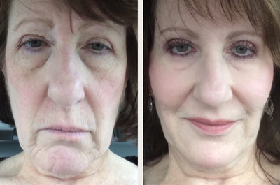 Juvederm before and after photo