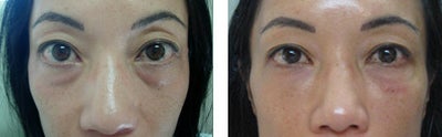 Eyelid Surgery before and after photo