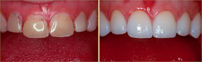 Porcelain Veneers before and after photo