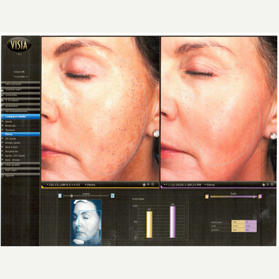 IPL before and after photo