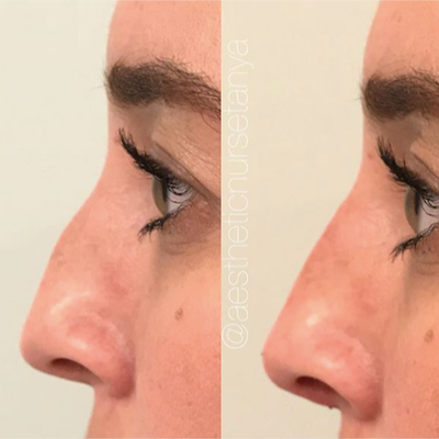 Nonsurgical Nose Job before and after photo