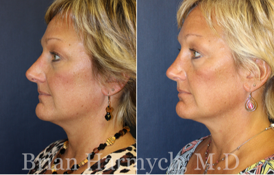 Revision Rhinoplasty before and after photo