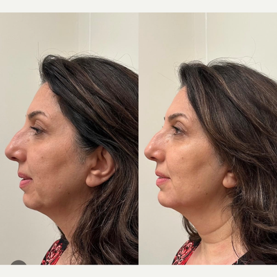 Radiesse before and after photo