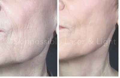 CO2 Laser before and after photo