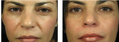 Radiesse before and after photo