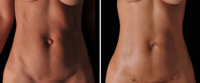 Belly Button Surgery before and after photo
