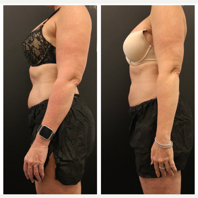 CoolSculpting before and after photo