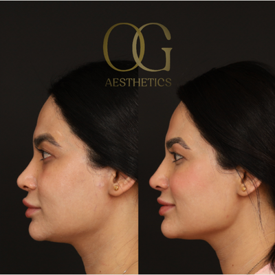 Revision Rhinoplasty before and after photo