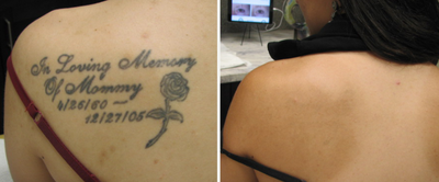 Tattoo Removal before and after photo