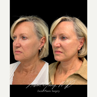 Deep Plane Facelift before and after photo