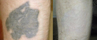 PicoSure before and after photo