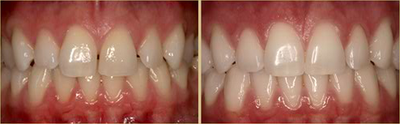 Invisalign before and after photo