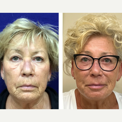 Mini Facelift before and after photo
