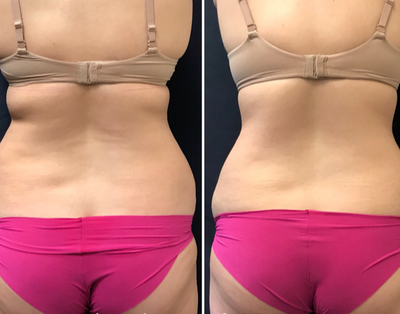 SculpSure before and after photo