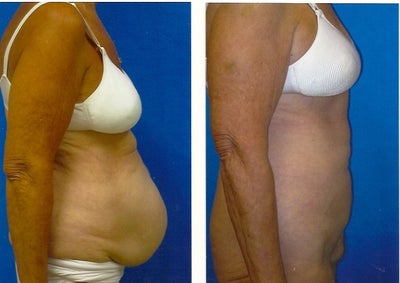 Tummy Tuck before and after photo