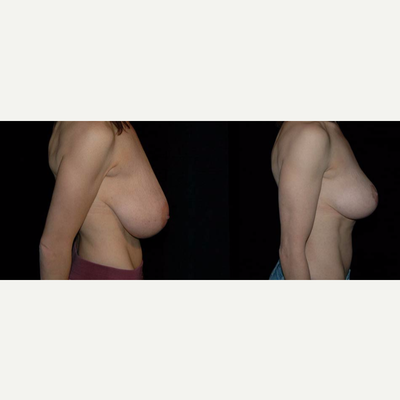 Breast Lift before and after photo