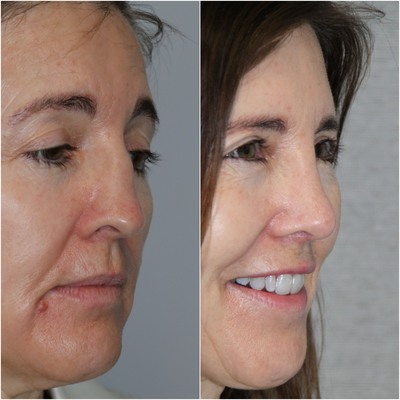 Revision Rhinoplasty before and after photo