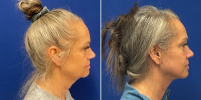 before and after image
