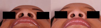 African American Rhinoplasty before and after photo