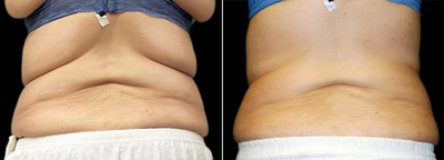 Vanquish before and after photo