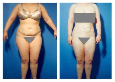 Liposuction before and after photo