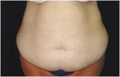 Tummy Tuck before and after photo